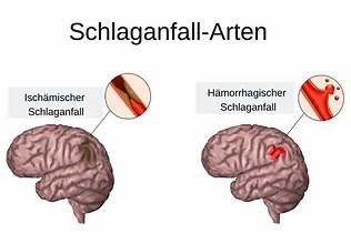 Charlotte Karlinder Schlaganfall